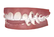 Bumper labial invisible