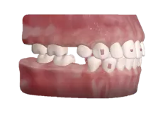Protocolo clásico de extracción dental