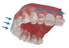Protocolo clásico de distalización molar
