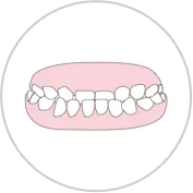 mordida cruzada anterior