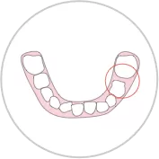 Arcos dentales estrechos / Apiñamiento dental