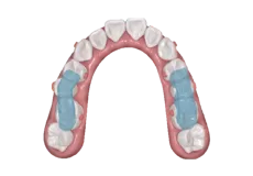 Dispositivo de reposicionamiento mandibular con férula oclusal