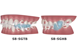 Dispositivo de avance mandibular