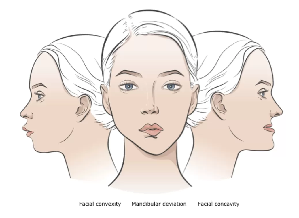 Tecnología de Reposicionamiento Mandibular