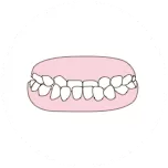 mordida cruzada