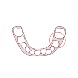 Espacio insuficiente para la erupción dental