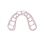 Arco dental estrecho y dientes apiñados