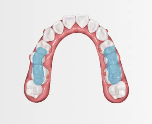 Dispositivo de Reposicionamiento Mandibular con Férula Oclusal