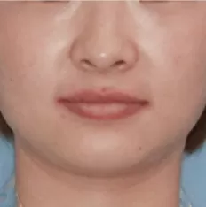 Fotografías faciales antes del tratamiento