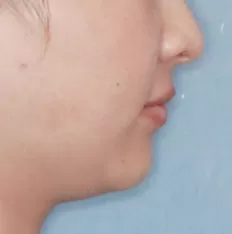 Fotografías faciales antes del tratamiento