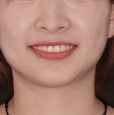 Fotografías faciales antes del tratamiento