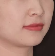Fotografías faciales antes del tratamiento