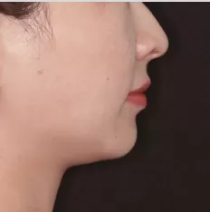 Fotografías faciales antes del tratamiento