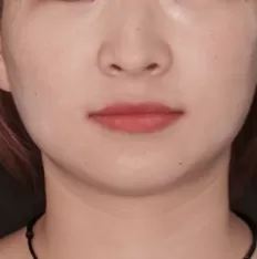 Fotografías faciales antes del tratamiento