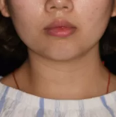 Fotos faciales antes del tratamiento