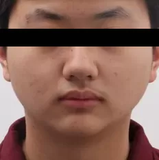 Fotografías faciales antes del tratamiento