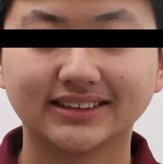 Fotografías faciales antes del tratamiento