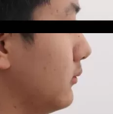 Fotografías faciales antes del tratamiento