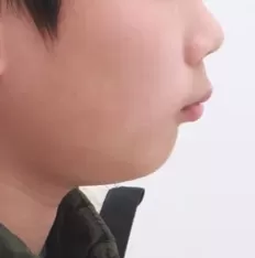 Fotografías faciales antes del tratamiento