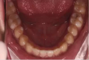 Fotos intraorales después del tratamiento