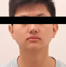 Fotografías faciales antes del tratamiento