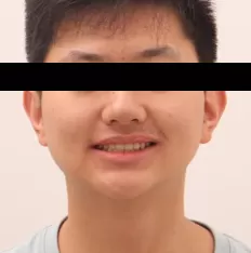 Fotografías faciales antes del tratamiento