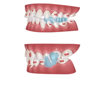S8 Dispositivo de reposicionamiento mandibular para avance mandibular