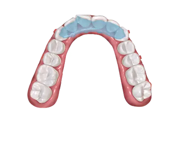 S9 Dispositivo de reposicionamiento mandibular con plano de mordida