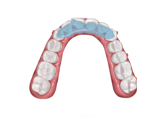 S9 Dispositivo de Reposicionamiento Mandibular con Plano de Mordida