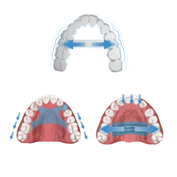 S11 Dispositivo palatal