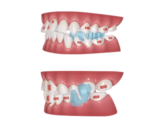 S8 Dispositivo de Reposicionamiento Mandibular para Avance Mandibular