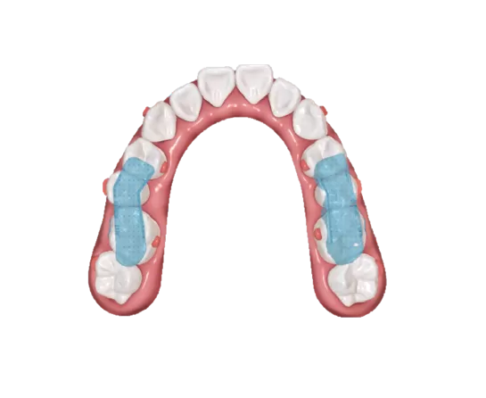 S10 Dispositivo de reposicionamiento mandibular con férula oclusal