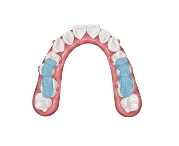 S10 Dispositivo de reposicionamiento mandibular con férula oclusal