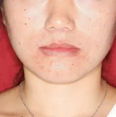Fotografías faciales antes del tratamiento