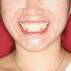Fotografías faciales antes del tratamiento