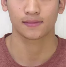Fotografías faciales antes del tratamiento