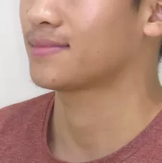Fotografías faciales antes del tratamiento