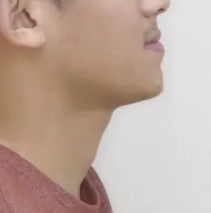 Fotografías faciales antes del tratamiento
