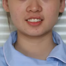 dientes-alineadores-invisibles-2.png