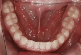 Fotos intraorales después del tratamiento