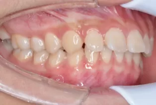 alineadores-de-enderezamiento-dental-4.png