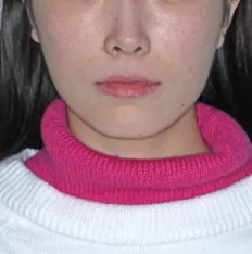 Fotos faciales antes del tratamiento