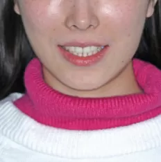 Fotos faciales antes del tratamiento