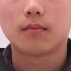 Fotografías faciales antes del tratamiento