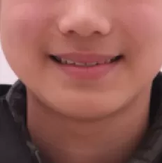 Fotografías faciales antes del tratamiento