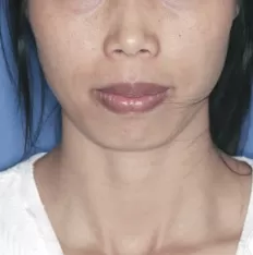 Fotografías faciales antes del tratamiento