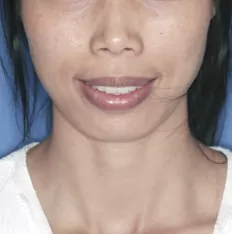 Fotografías faciales antes del tratamiento