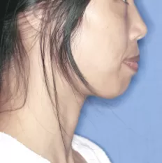 Fotografías faciales antes del tratamiento