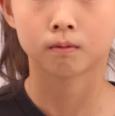 Fotografías faciales antes del tratamiento
