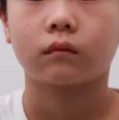 Fotografías faciales antes del tratamiento